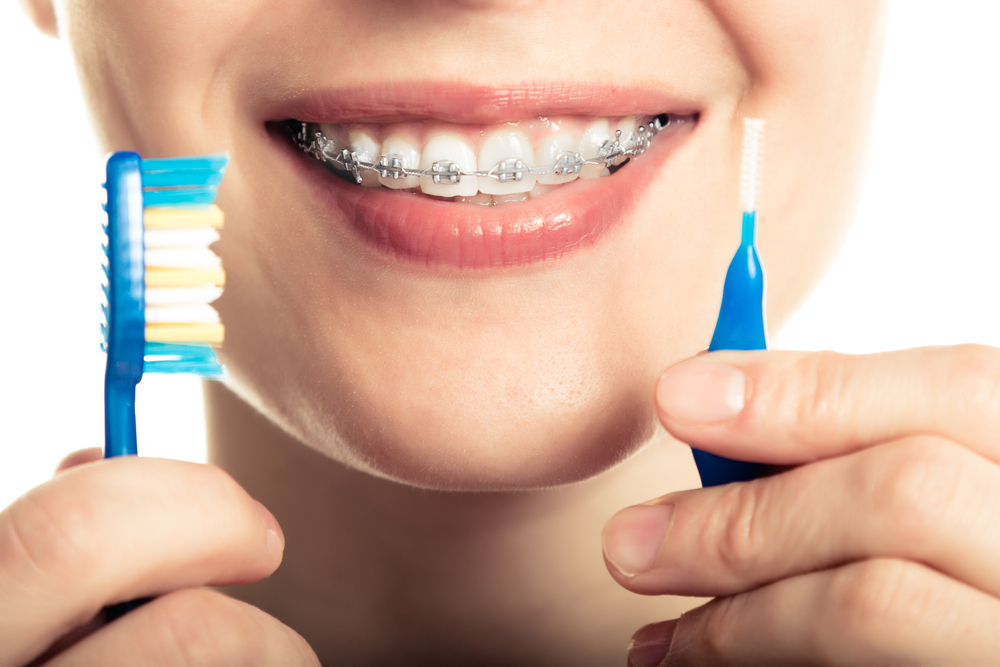 how to care for braces, how to care for aligners