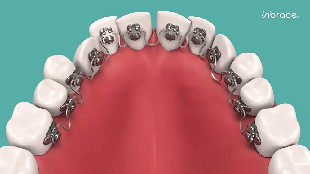 Inbrace Bergen Orthodontics