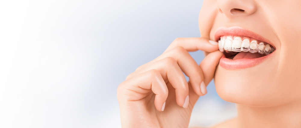 Woman Putting In Her Invisalign Aligners